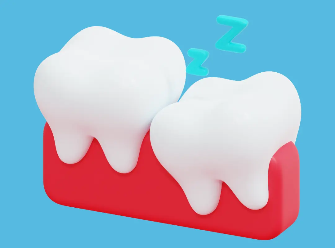 Decay affecting a wisdom tooth and the adjacent second molar