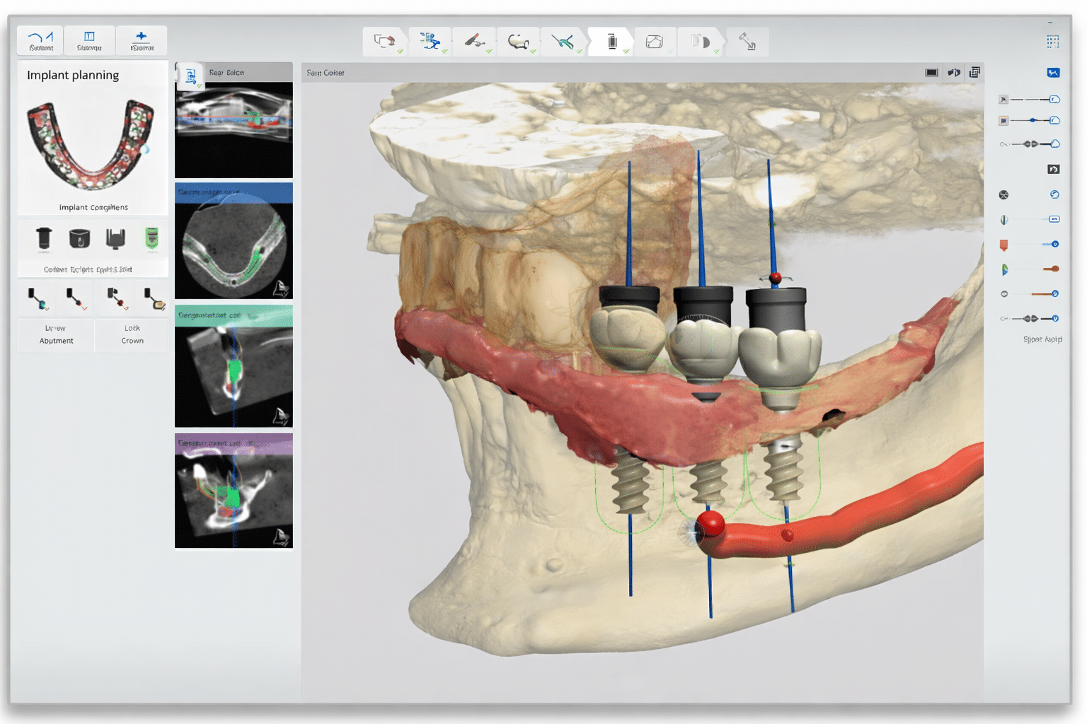 Digital dental implant planning with 3D CBCT imaging at Meiplus Dentalcare