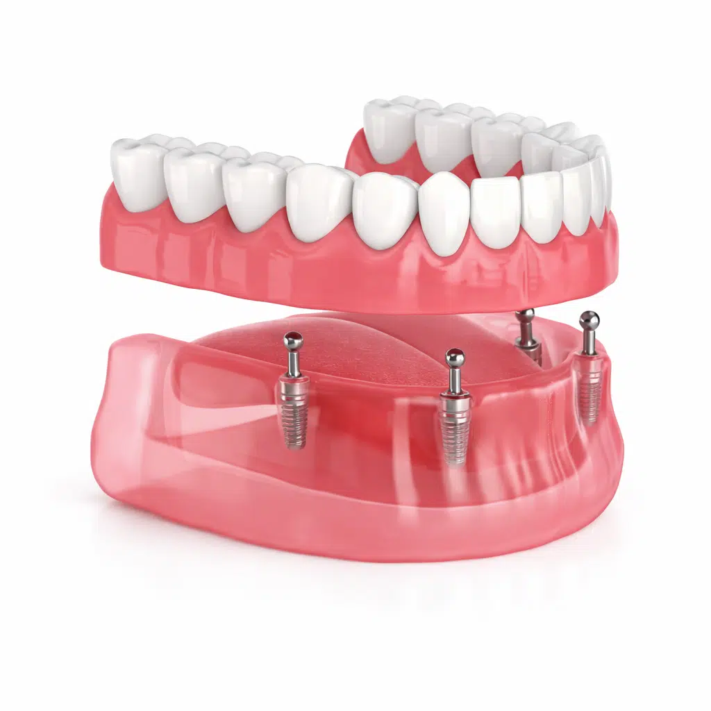 Implant-supported overdenture clipping onto dental implants