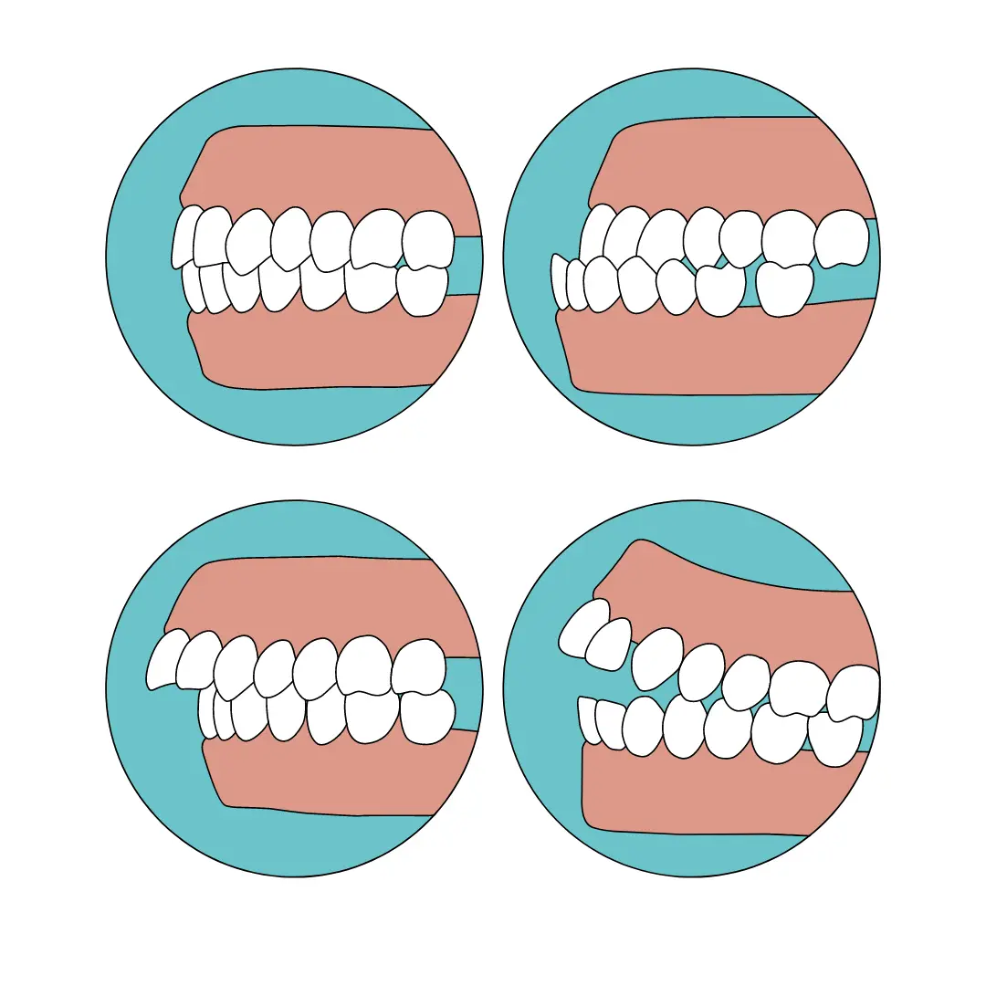 Orthodontic conditions treated at Meiplus Dentalcare Singapore