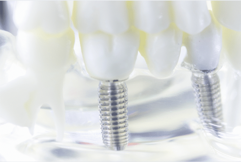 all-on-4 dental implants singapore