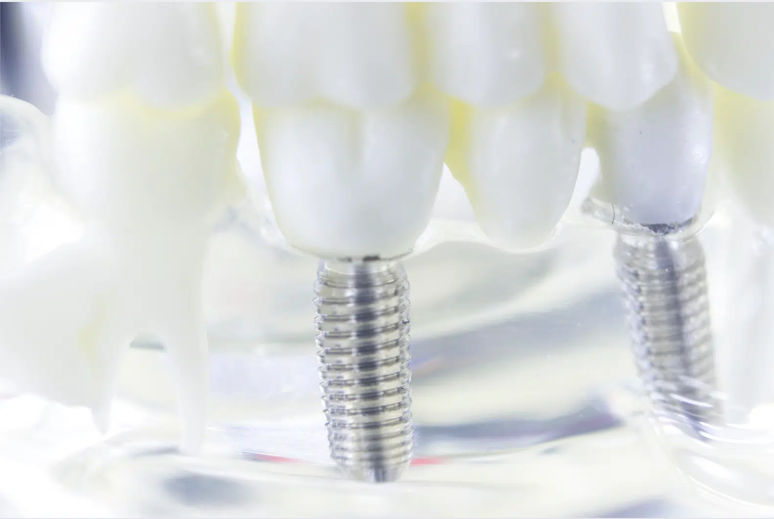 All-on-4 Dental Implants in Singapore
