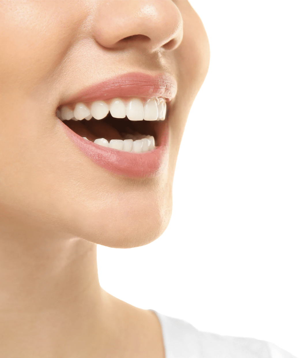 Dental veneers at Meiplus Dentalcare Singapore
