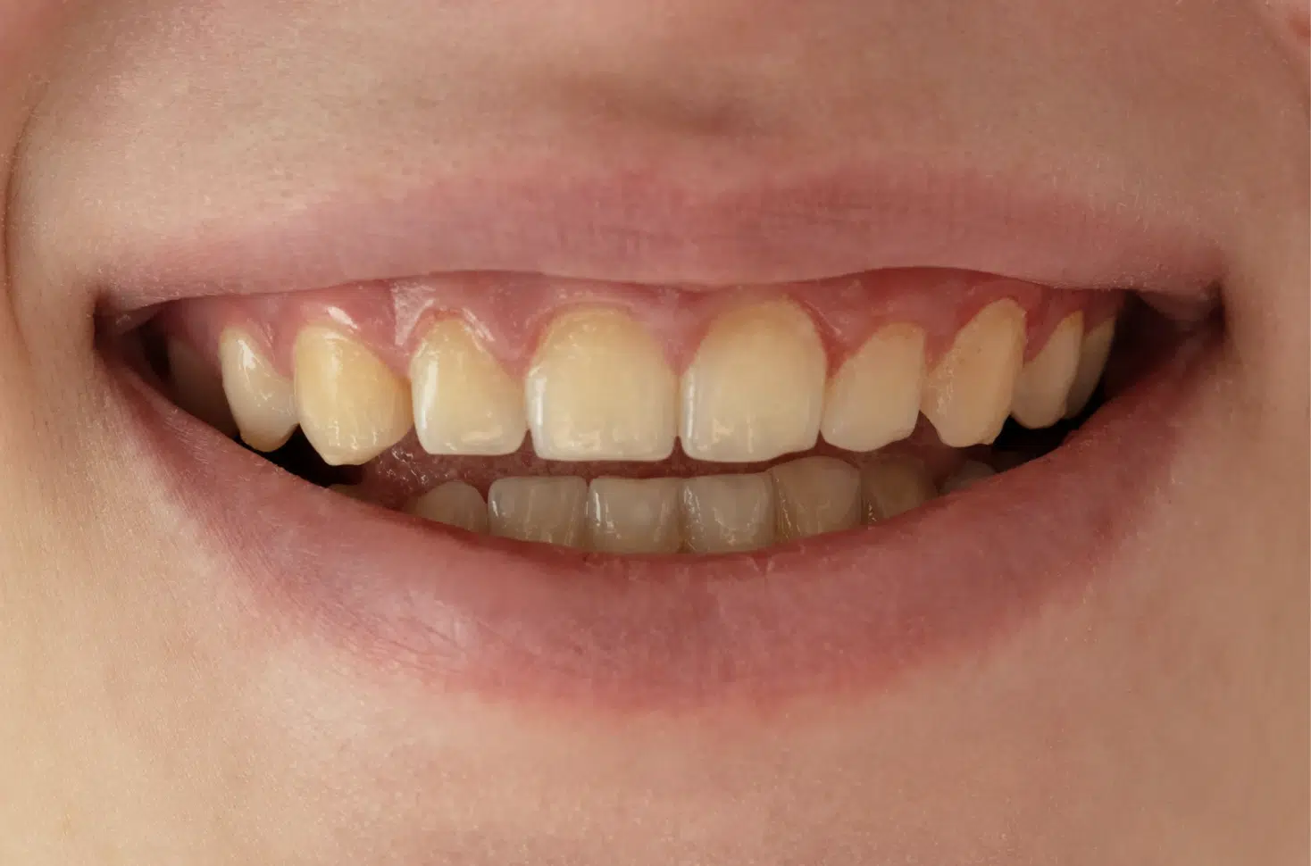 Professional teeth whitening treatment at Meiplus Dentalcare Singapore