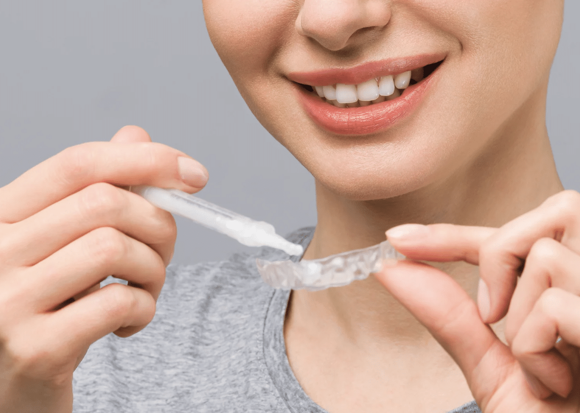 Professional-strength whitening gel applied to the teeth