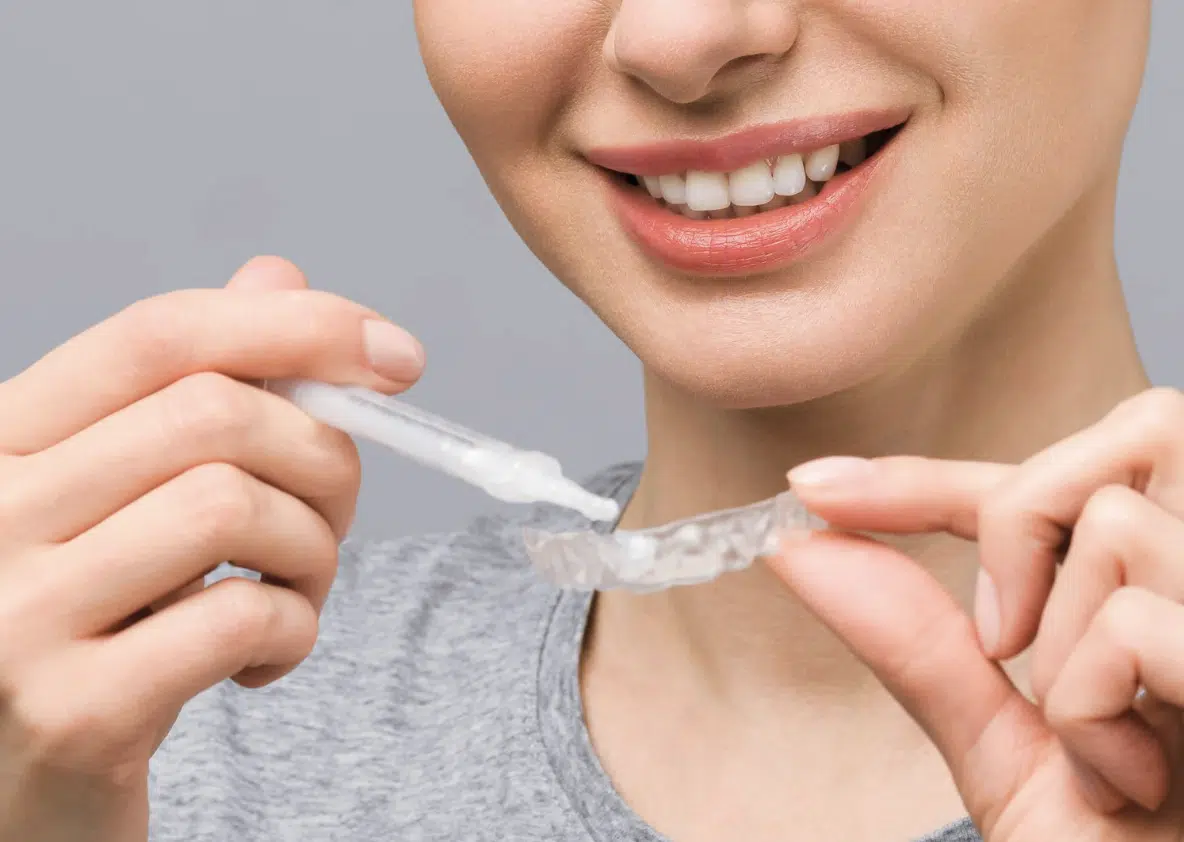 Professional-strength whitening gel applied to the teeth