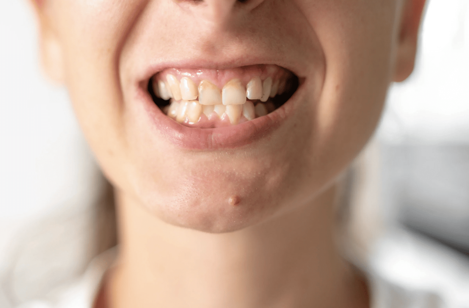 Crowded teeth that are difficult to clean thoroughly