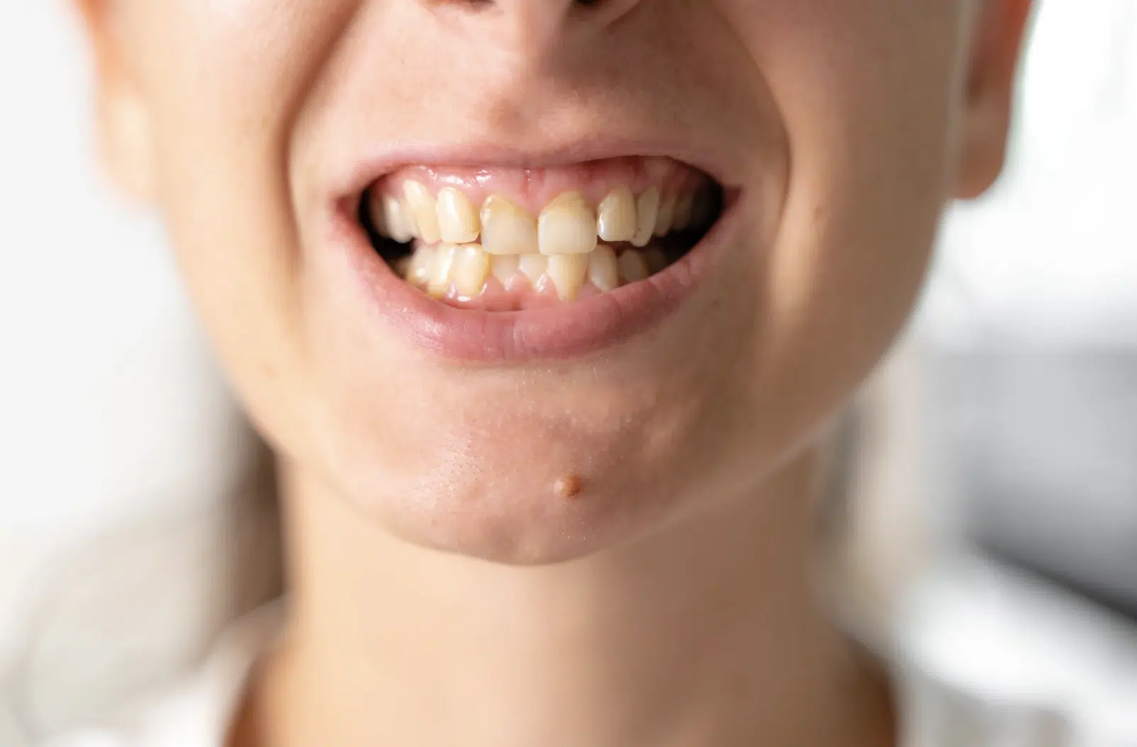 Visible tartar or staining