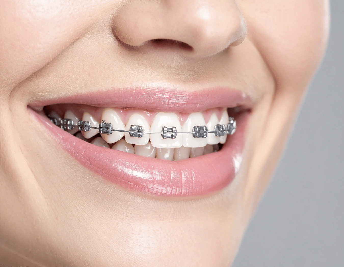 Metal braces with stainless steel brackets at Meiplus Dentalcare Singapore