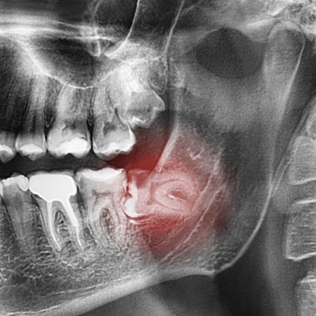Impacted wisdom tooth unable to fully erupt