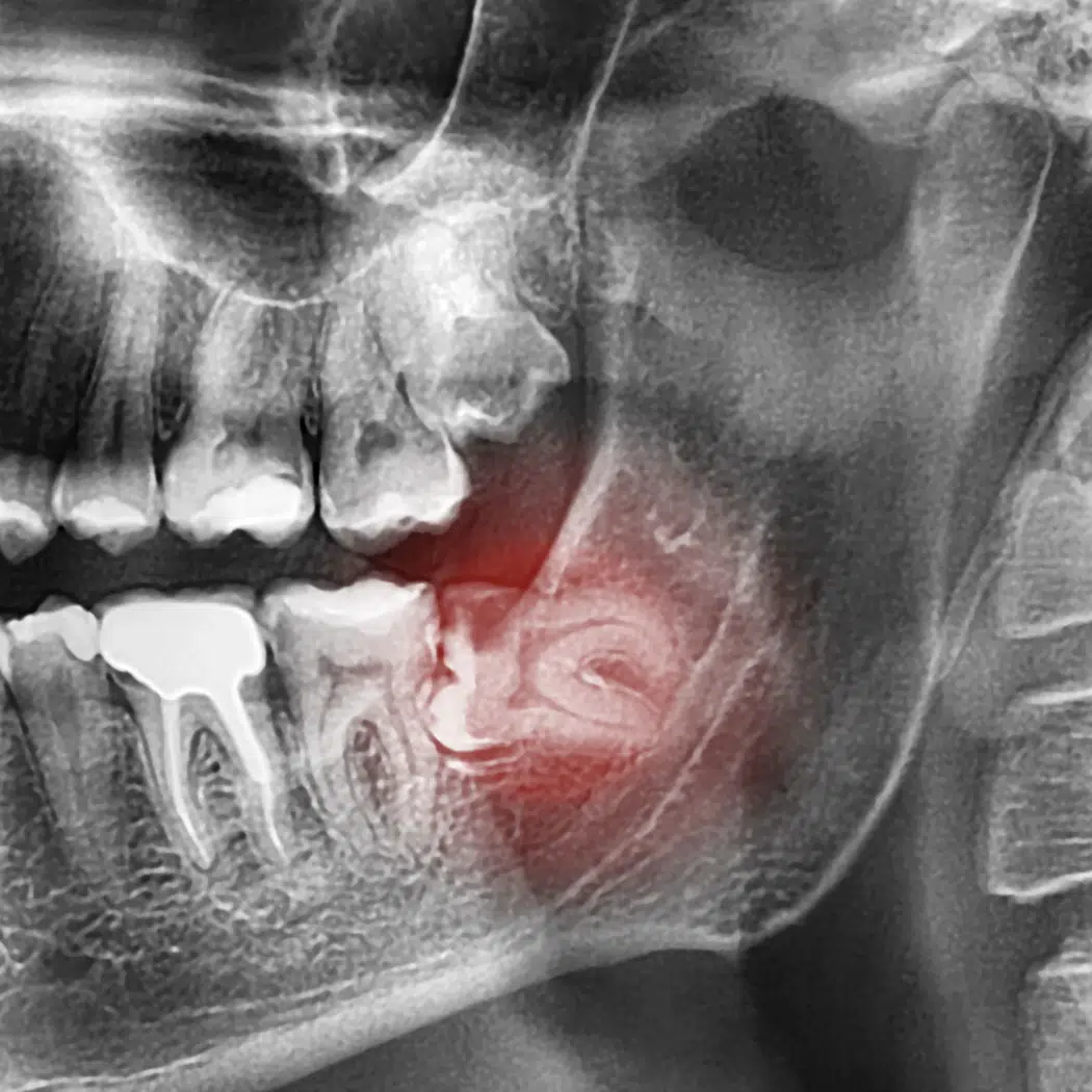 Impacted wisdom tooth unable to fully erupt