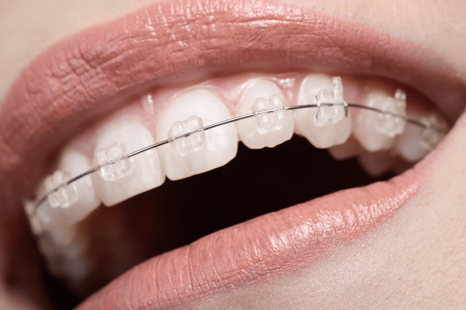 Ceramic tooth-coloured braces at Meiplus Dentalcare Singapore