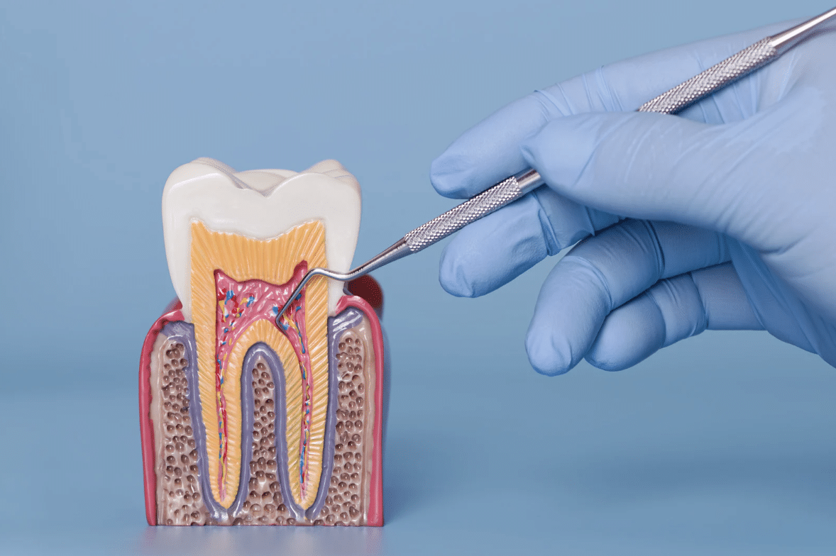 Periodontitis Deep Cleaning
