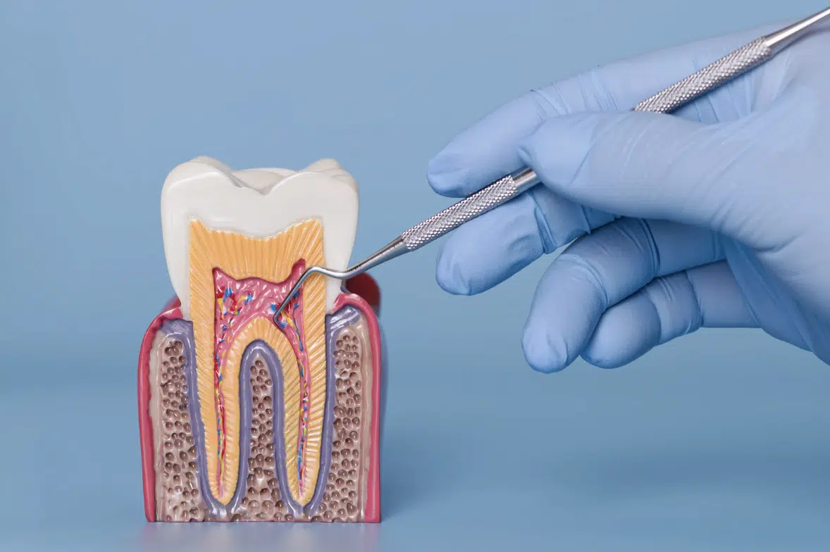 Periodontitis Deep Cleaning