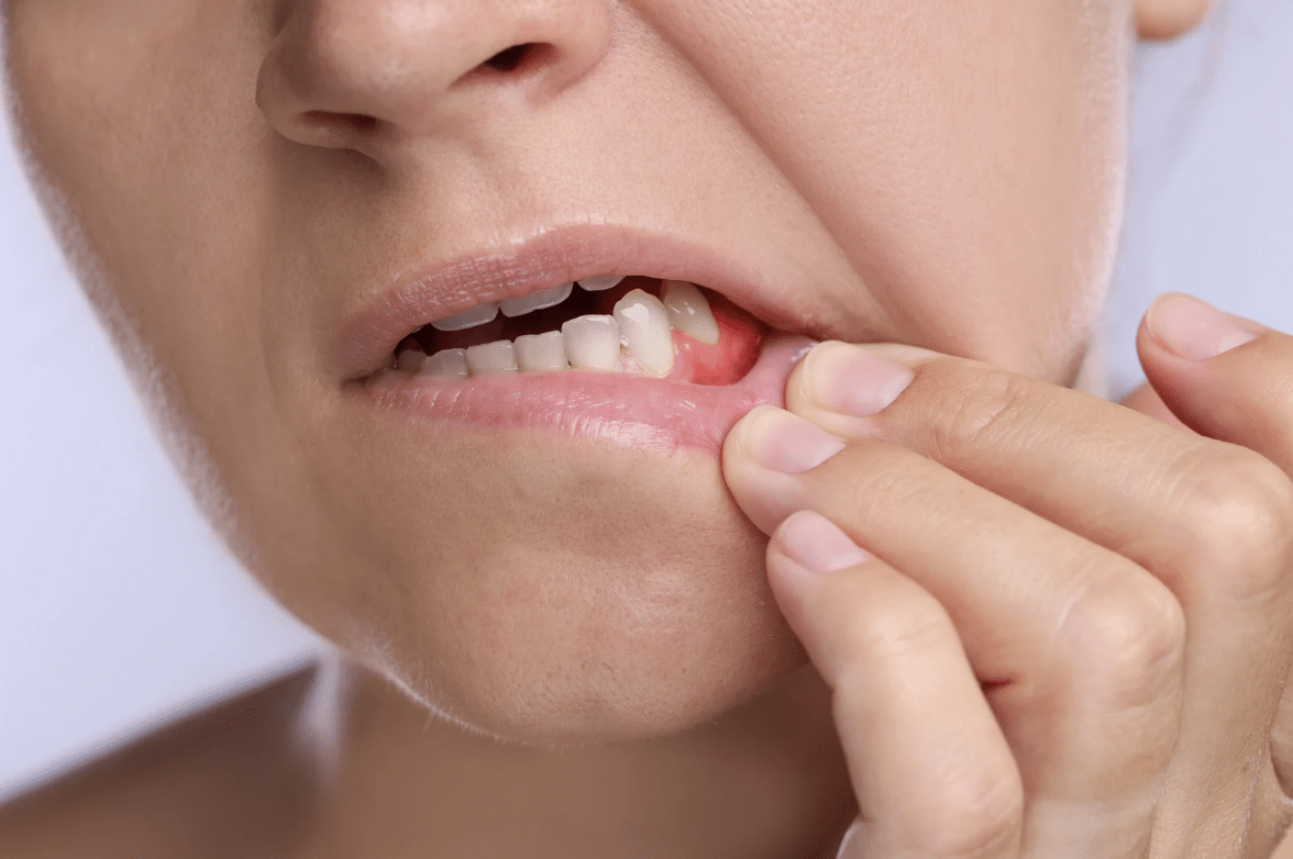 Gum Disease Treatment