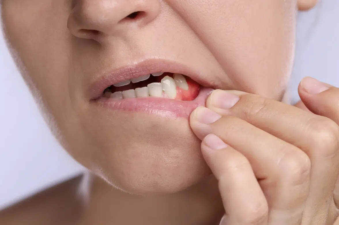 Gum Disease Treatment