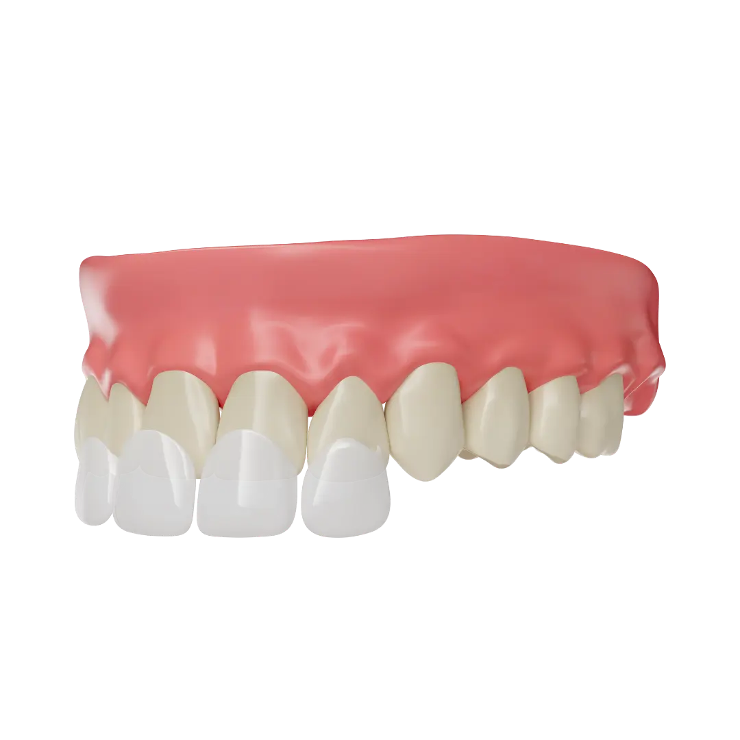 Dental veneers as part of a smile makeover at Meiplus Dentalcare