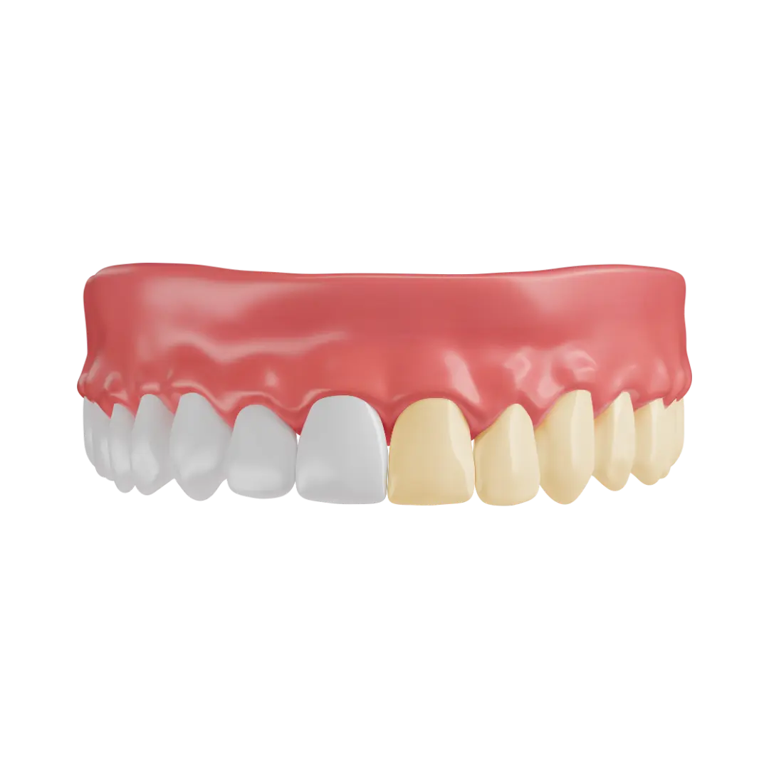 Teeth whitening as part of a smile makeover at Meiplus Dentalcare