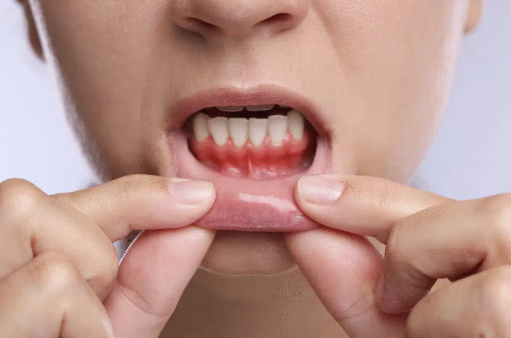 gum disease img gum disease img