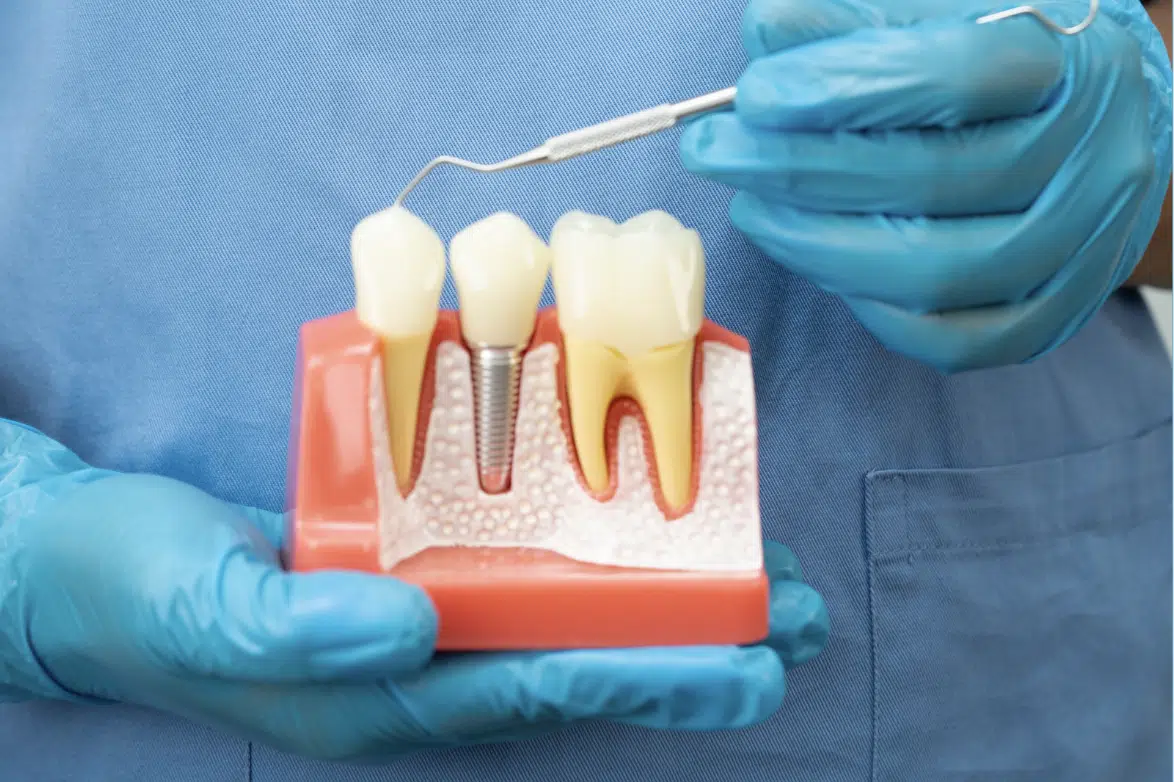Tooth Replacement Options