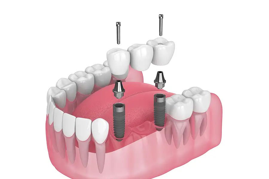 types of dental bridges