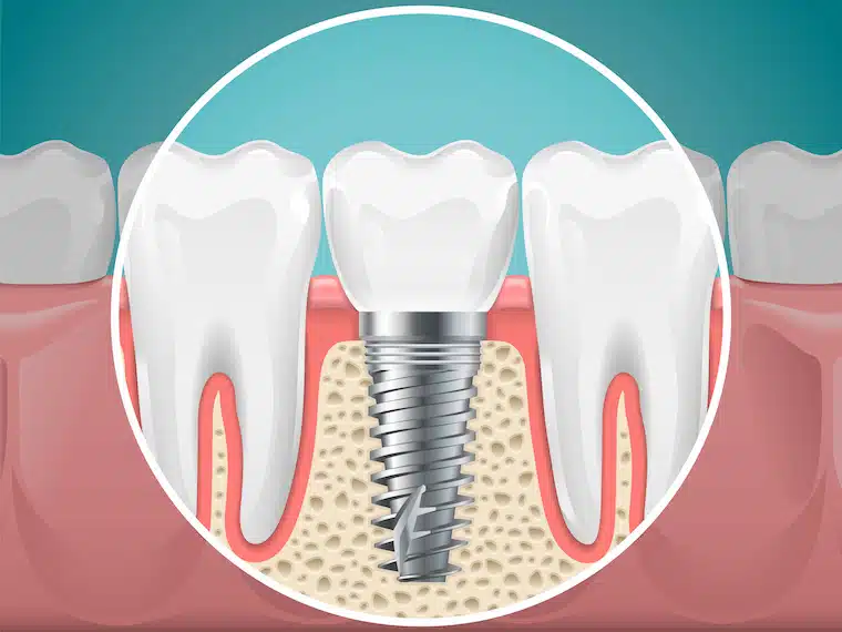 Dental bone graft diagram