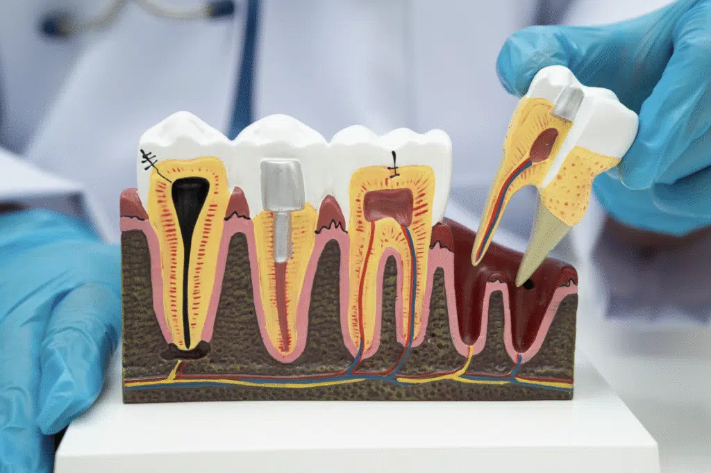 Root Canal Treatment