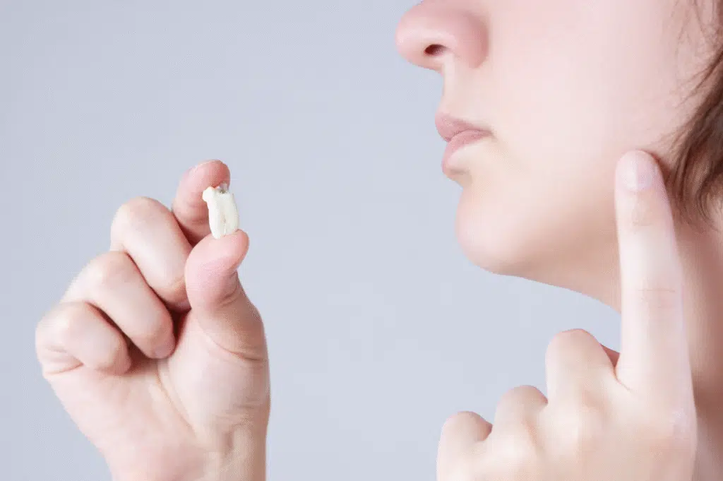 Wisdom Tooth Removal