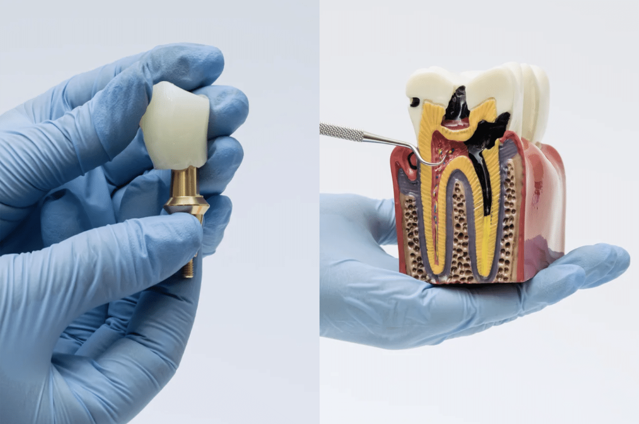 Root canal treatment removing infected pulp from inside a tooth at Meiplus Dentalcare Singapore