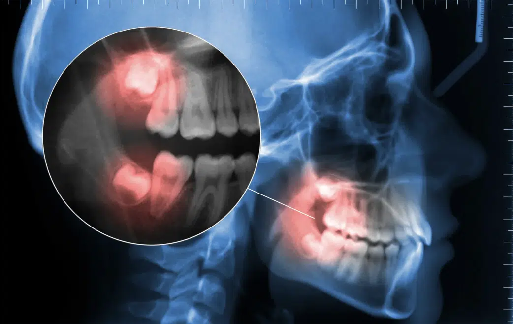 Wisdom tooth assessment at Meiplus Dentalcare Singapore