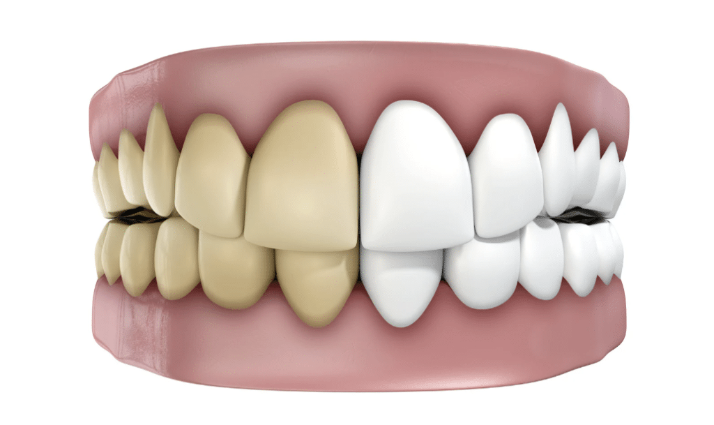 tooth discolouration