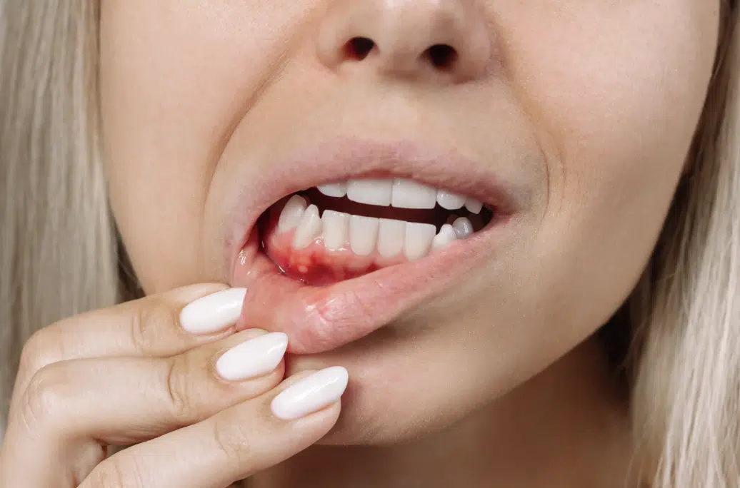 Gum infection and inflammation around a partially erupted wisdom tooth