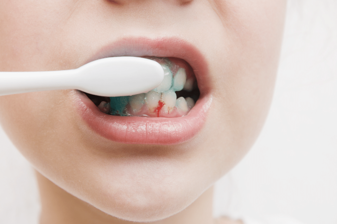Bleeding gums when brushing or flossing