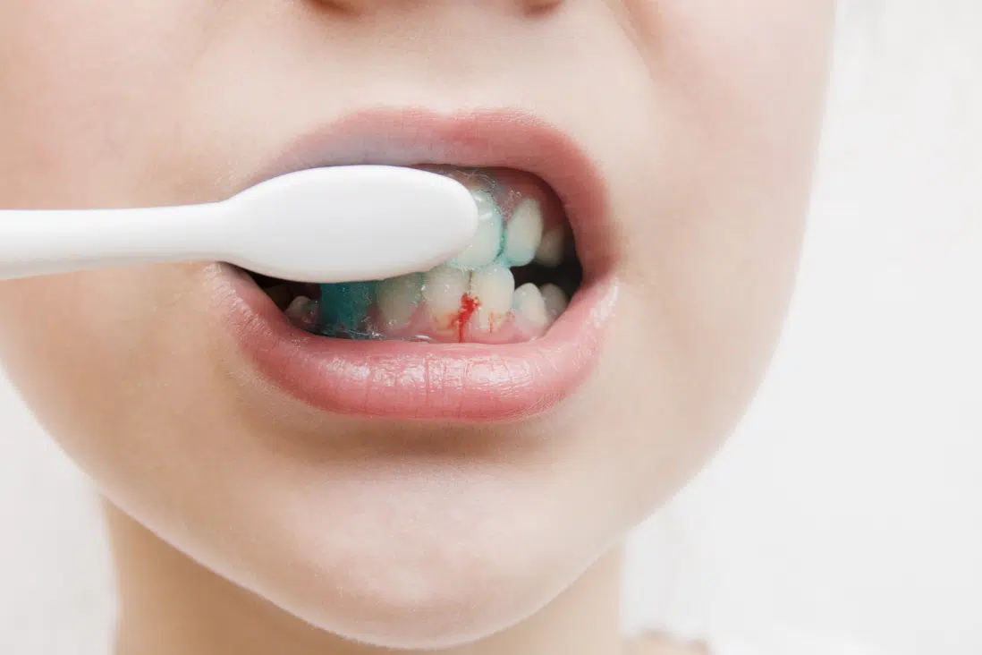 Bleeding gums when brushing or flossing