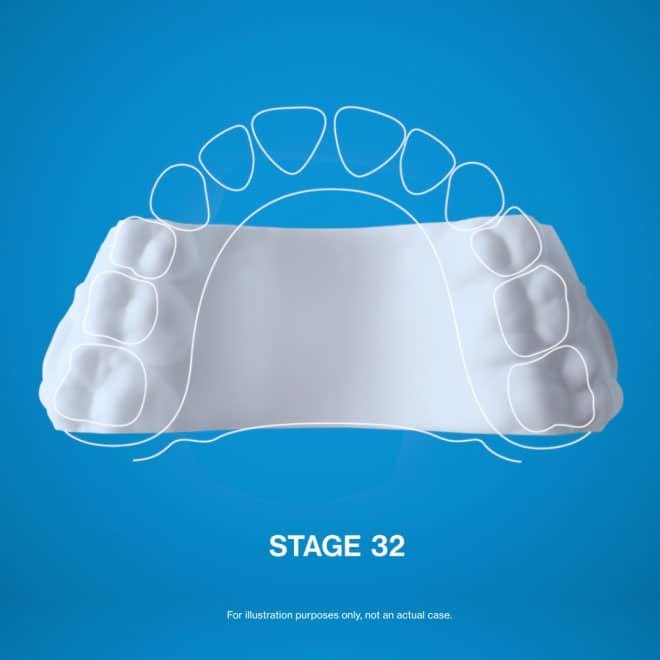 Invisalign Palatal Expander System stages for children aged 6 to 11