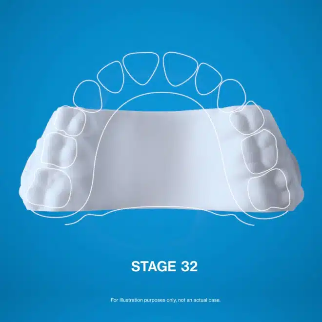 Invisalign Palatal Expander System stages for children aged 6 to 11