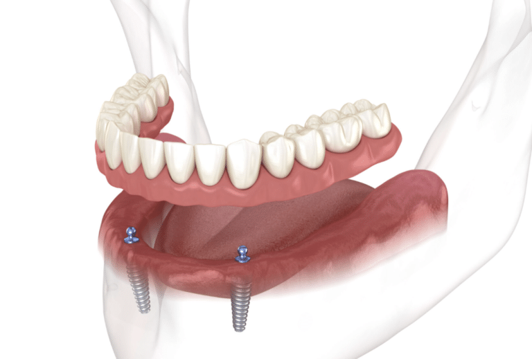 overdentures-in-singapore